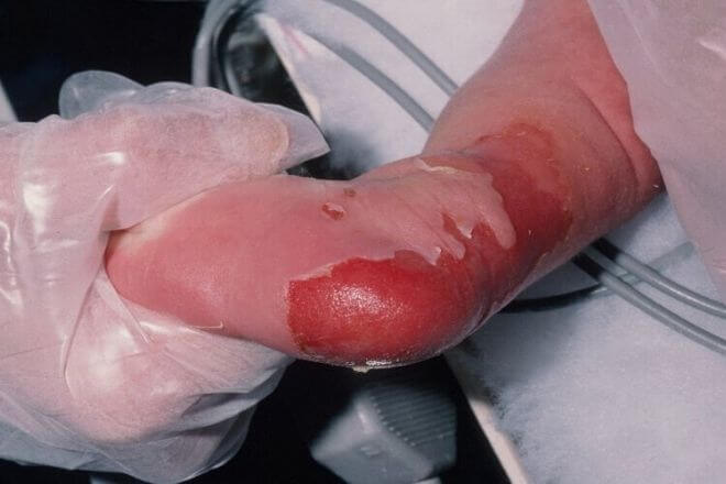 Oštećenje kože zbog bulozne epidermolize