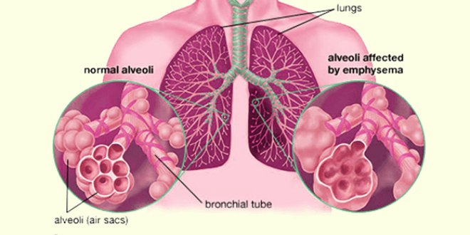Pluća kod emfizema