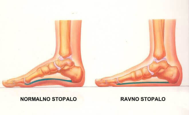 ralika između normalnog i ravnog stopala