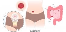 Ileostoma