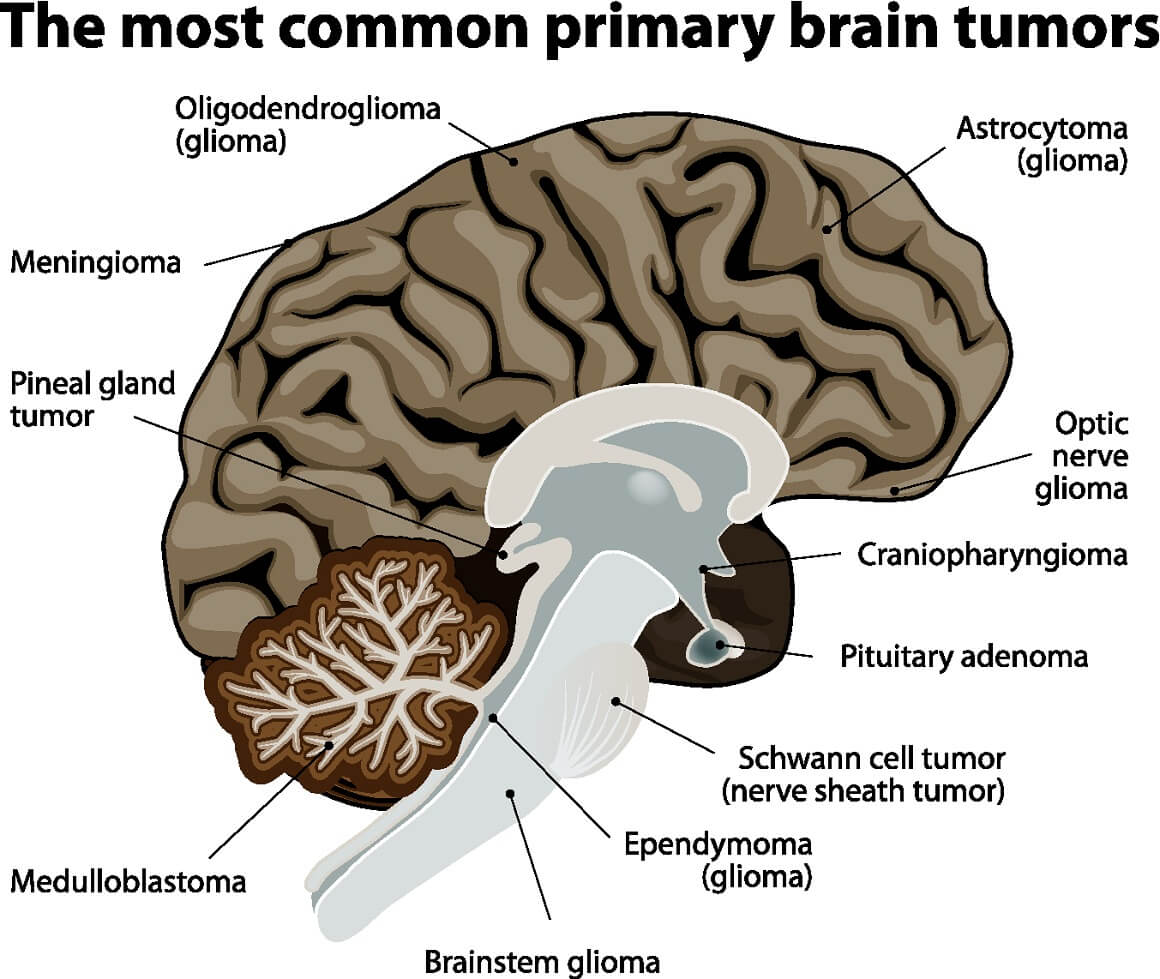 Primarni tumor na mozgu