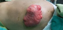 Stoma - komplikacije