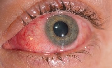 Virusni konjunktivitis