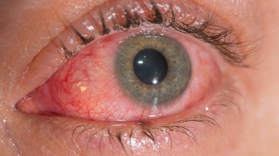 Virusni konjunktivitis