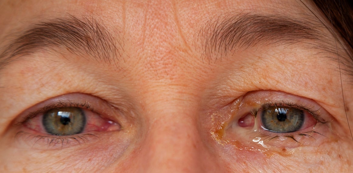 Virusni konjunktivitis - simptomi