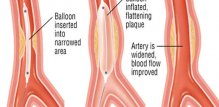 Angioplastika