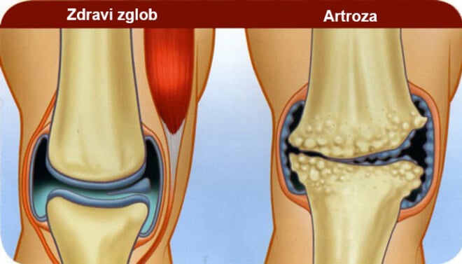 artroza liječenje noga glina