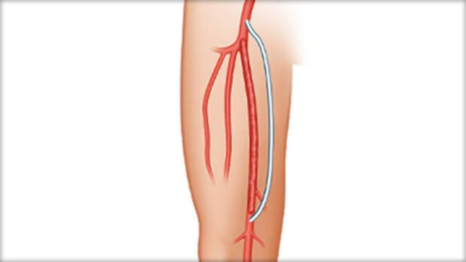 pročišćavanje krvnih žila u hipertenzije