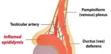 Bol u testisima epididimitis