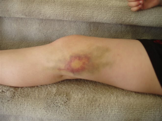 ozljeda bol u modricama koljena