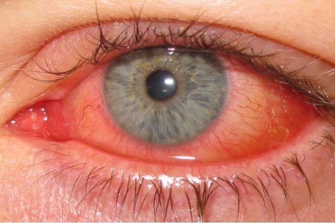 konjunktivitis crvenilo oka