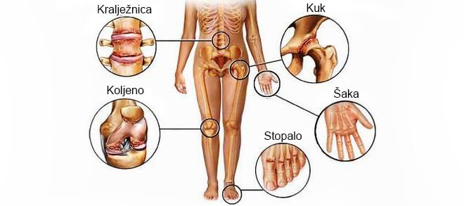 simptomi artroze četkom i liječenje