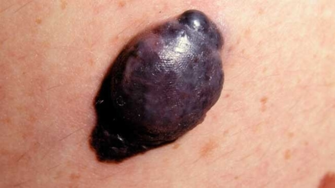 nodularni melanom