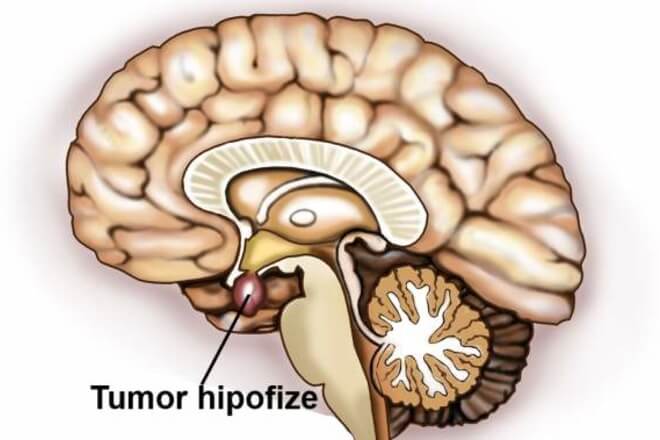 tumor hipofize simptomi