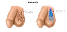 Varikocele