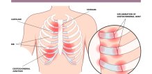 Kostohondritis ili upala hrskavice