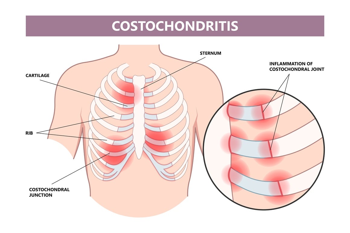 Kostohondritis ili upala hrskavice
