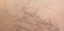 Paučinaste vene su uz varikozne (proširene) vene vrlo česta pojava u današnjoj populaciji