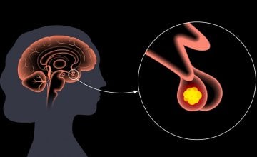 Tumor hipofize Kako ga prepoznati na vrijeme