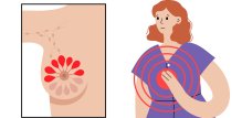 Upala dojke u menopauzi
