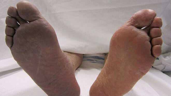 bol u zglobovima noge 60 godina