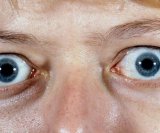 gravesova-oftalmopatija