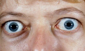 gravesova-oftalmopatija
