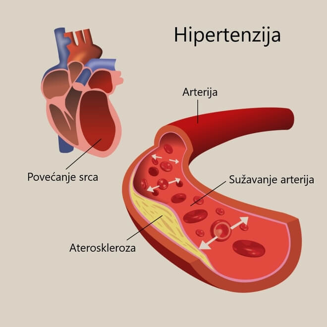 Je li moguće da srčana hipertenzija?