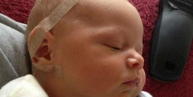 Korekcija ušiju nakon rođenja