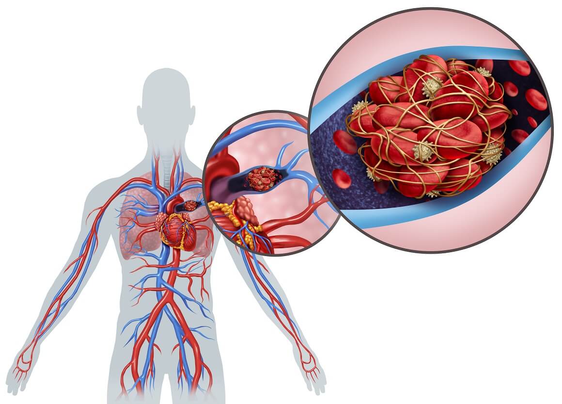 krvni ugrušak može blokirati plućne krvne žile i stvarati bol
