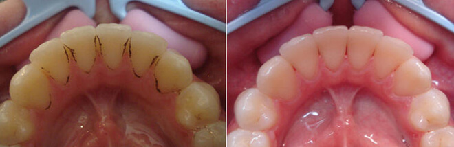 pjeskarenje zubi prije i poslije