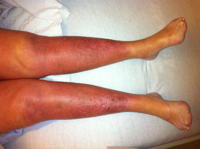 laserski pregled liječenja artroze koljena