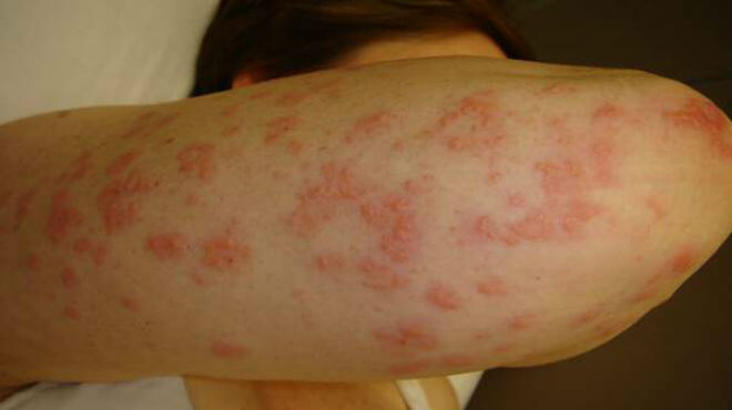 Dermatitis herpetiformis slike