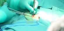 Hijatalna hernija operacija