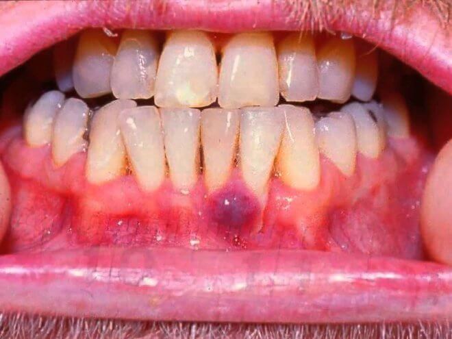Kaposijev sarkom u ustima