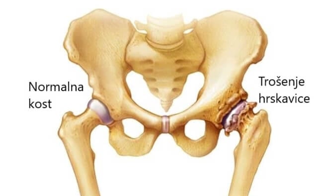 što učiniti s bolovima u zglobovima kuka liječenje osteoartritisa gležnja