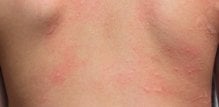Kontaktni alergijski dermatitis