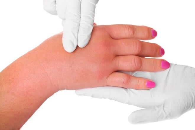reumatoidni artroza akutna bol u zglobovima kako se ublažiti