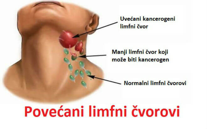 povećavaju se limfni čvorovi u zglobovima i mišićima)