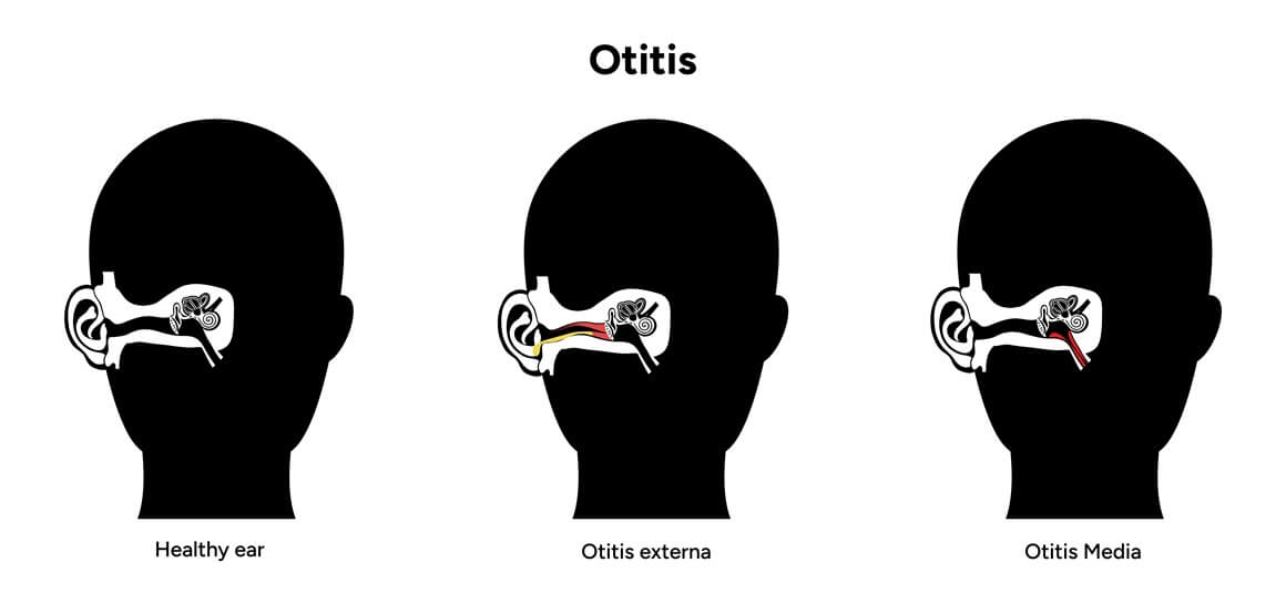 upala uha - medicinski naziv