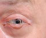 Bakterijski konjunktivitis