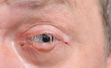 Bakterijski konjunktivitis