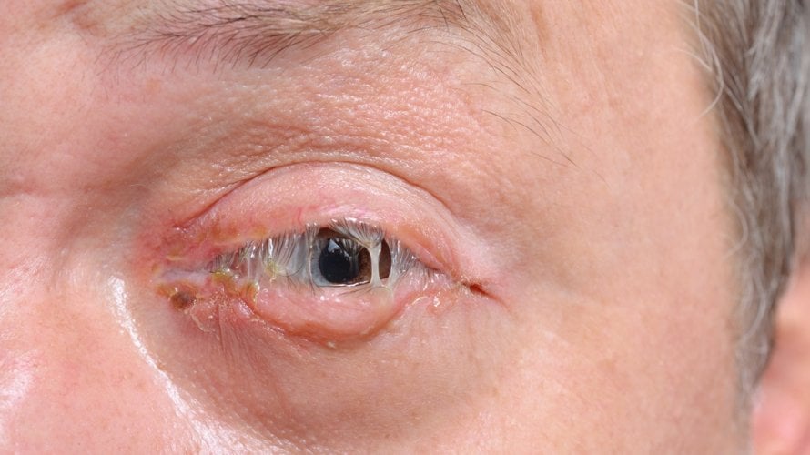 Bakterijski konjunktivitis