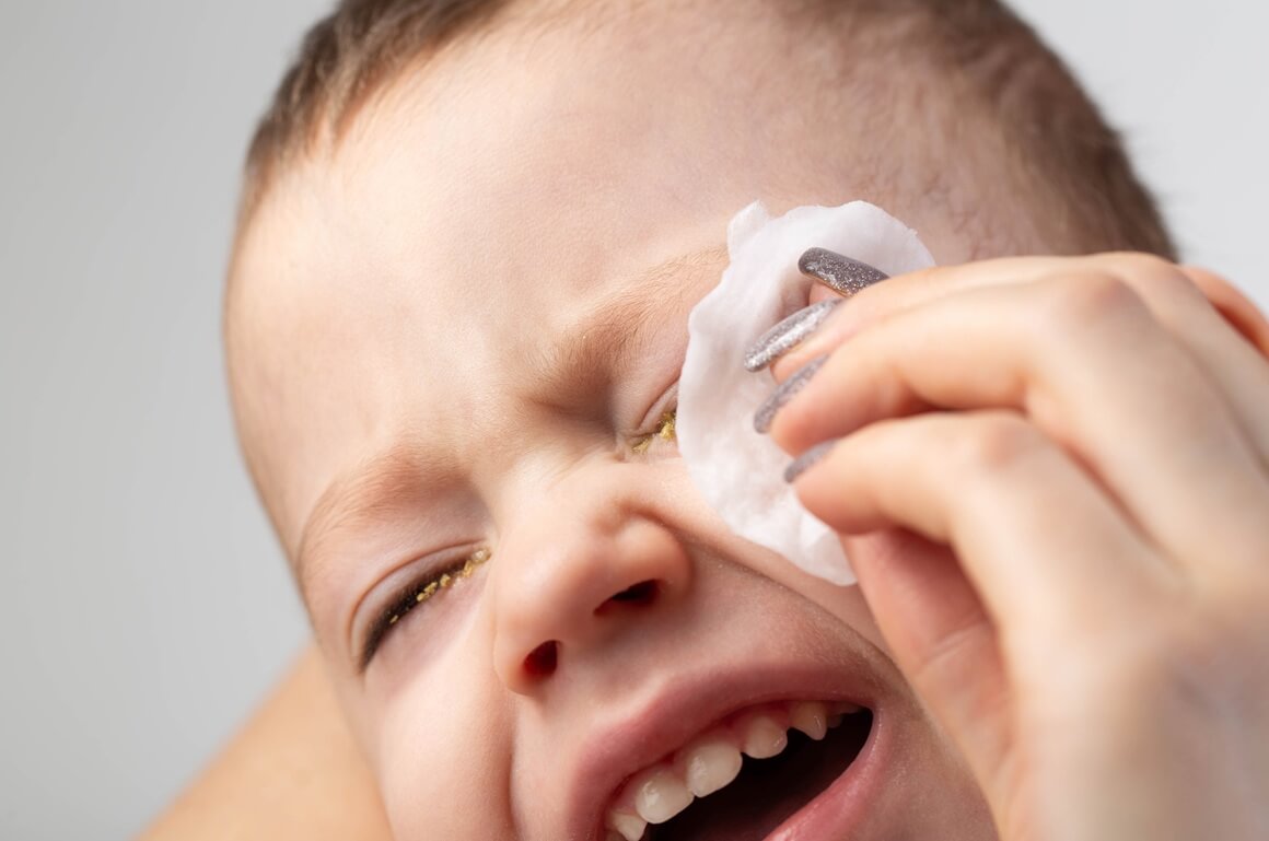 Bakterijski konjunktivitis - liječenje