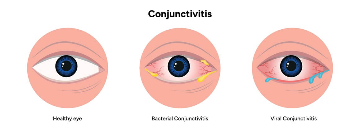Bakterijski konjunktivitis - simptomi