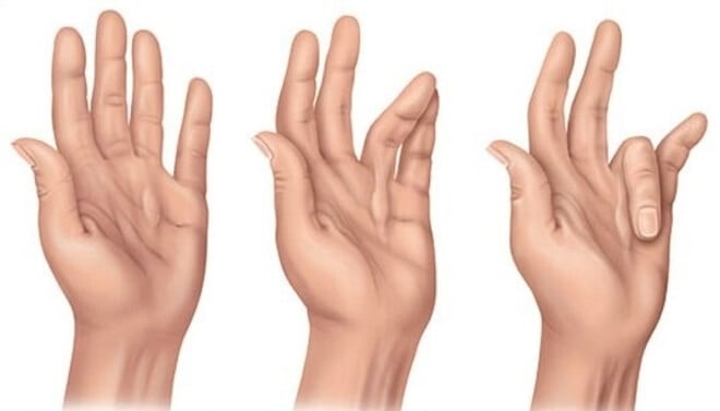 uzrok boli u zglobu prsta na ruci liječenje prve faze artroza deformansa
