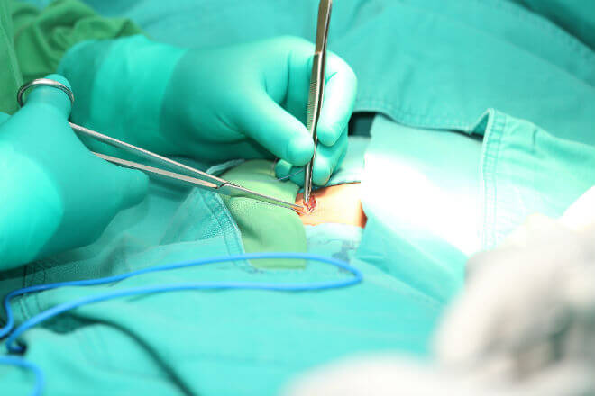 operacija hernije