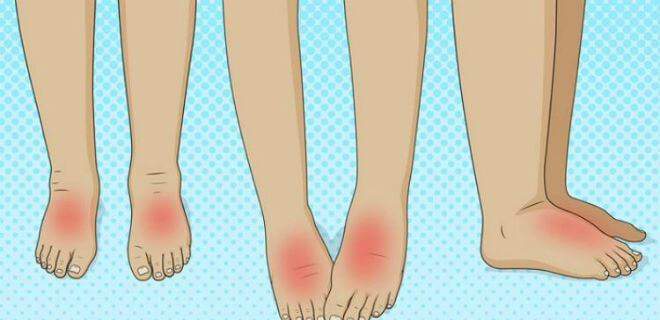 oticanje stopala liječenjem artroze celer artroza liječenje