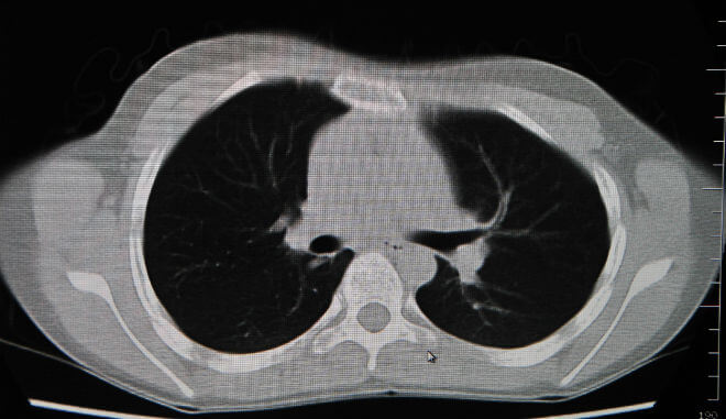 CT pluća