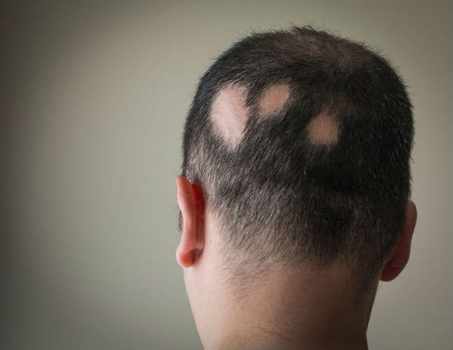 alopecija areata